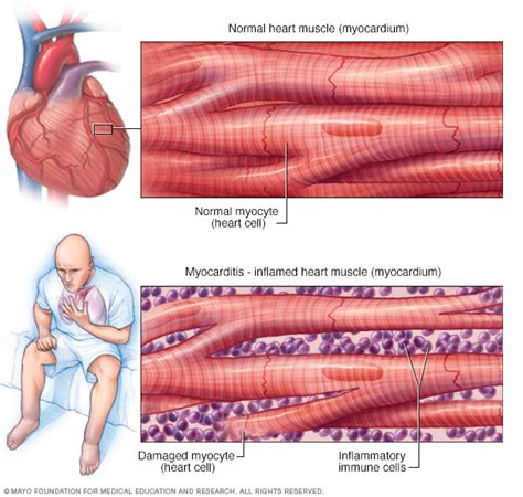 myocarditis disease reference guide drugscom