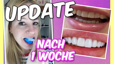 Neue Zahn Veneers I Erfahrungen Nach Woche Veneera Tragen Veneer