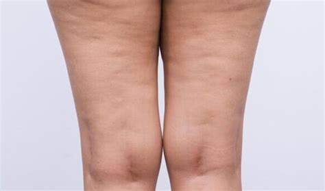 Lipedema O Que É Sintomas E Tratamento Qizr