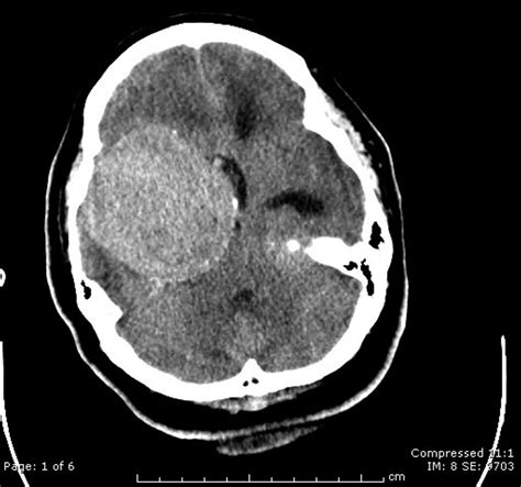 Noncontrast Axial Ct Image Demonstrates A Large Extra Axial Mass In The