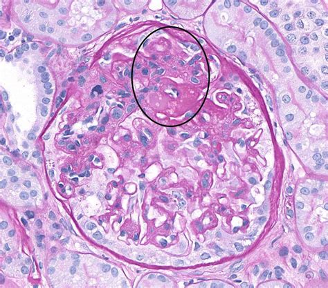 What Is Focal Segmental Glomerulosclerosis Fsgs Chronic Kidney