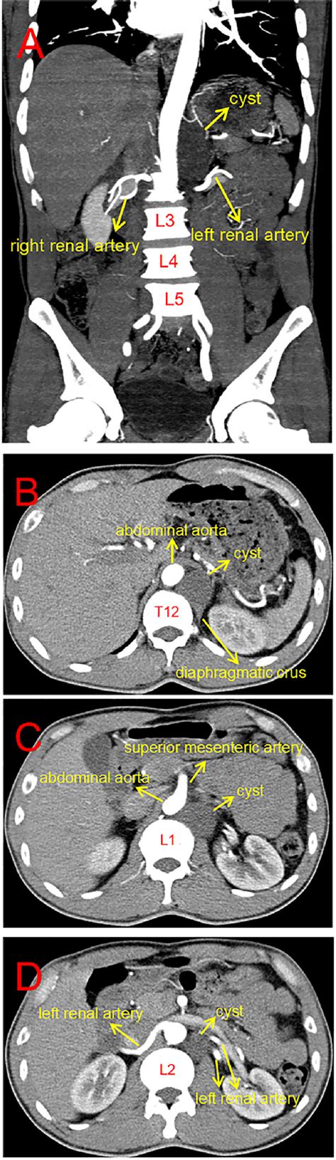 Figure From Retroperitoneal Bronchogenic Cyst With Fluidfluid Level