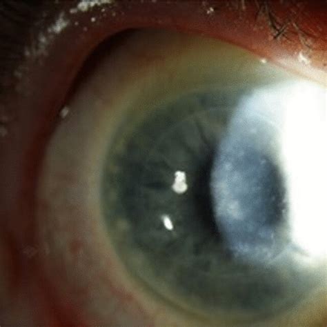 Example of the cornea with classic lattice corneal dystrophy type 1 ...