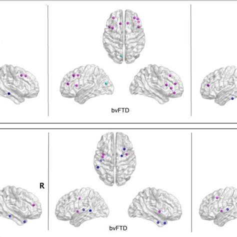 Cortical Thickness Correlation Network Measures Node Degree A And