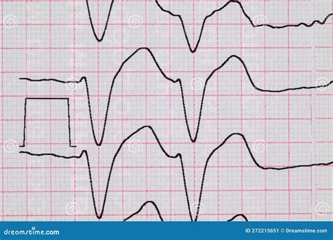 Ecg With Rhythm Disturbance Ventricular Extrasystole Close Up