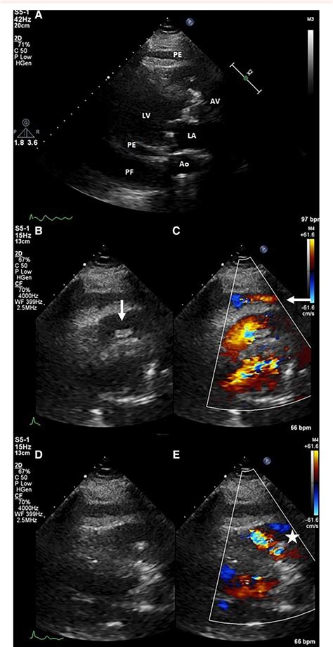 Figure 1 From Staphylococcus Lugdunensis Infective Endocarditis With Perforation Of The Sinus Of