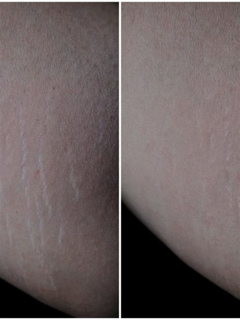 Stretch Marks Houston Tx Chrysolite Aesthetics