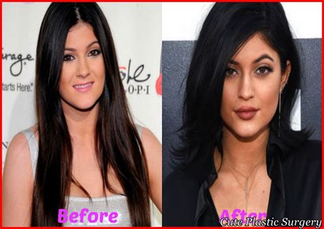 Kylie Jenner Plastic Surgery Transformation - Celebrities Plastic Surgery