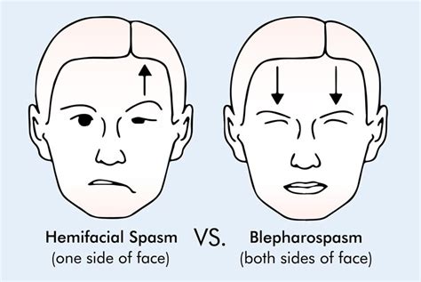 Hemifacial Spasm Causes And Symptoms