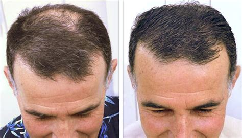 Dermmatch Hair Loss Concealer Hairloss Photo Gallery