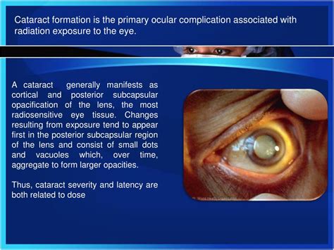 Ppt Radiation Protection Eyes Powerpoint Presentation Free