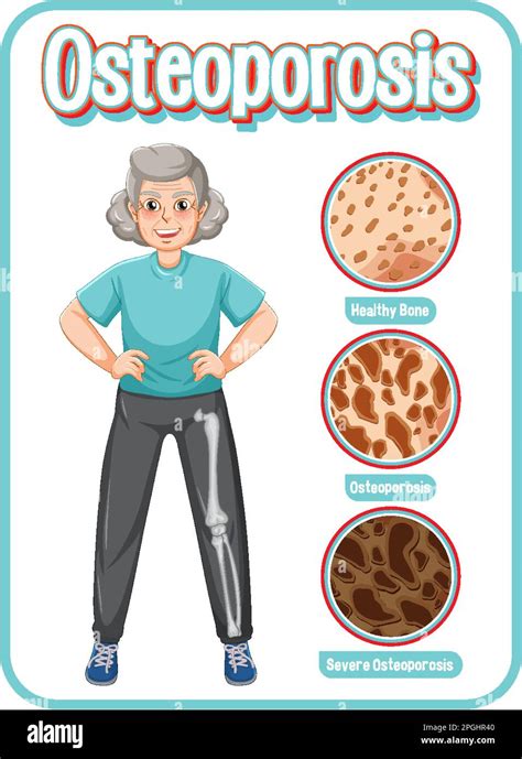 Comparison Of Normal Bone And Bone With Osteoporosis In Old People