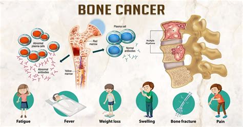 Bone Cancer Symptoms Causes And Treatment