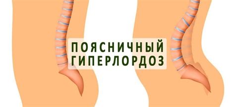 Гиперлордоз: что это, причины, симптомы, лечение, анатомия