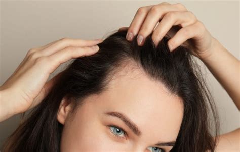 Receding Hairline In Women Symptoms Causes And Treatments Female