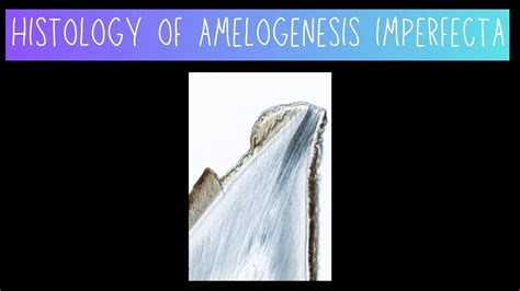 Histology of Amelogenesis Imperfecta - Dentistry - YouTube