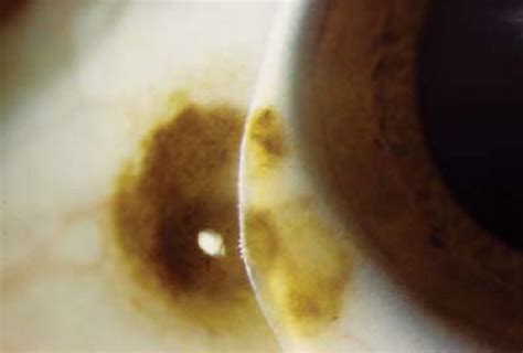 Conjunctiva Ento Key