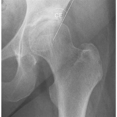 This radiograph documents the measurement of the acetabular roof ...