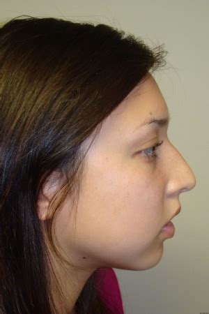 Rhinoplasty Before And After Grover Aesthetics