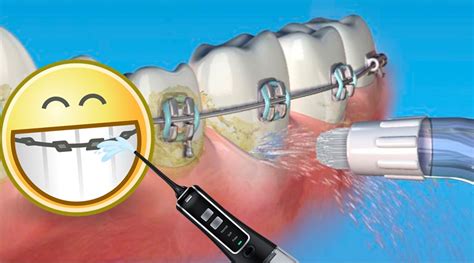 Irrigador Dental Razones Para Usarlo Soluci N Dental Dentistas