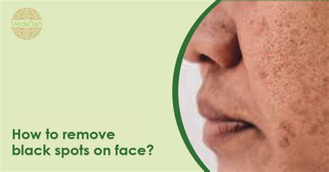 How To Remove Black Spots On Face Vedelan