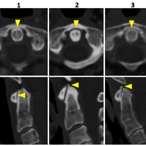 Imaging examples of osteoarthritis of the atlanto-axial joint. Imaging ...