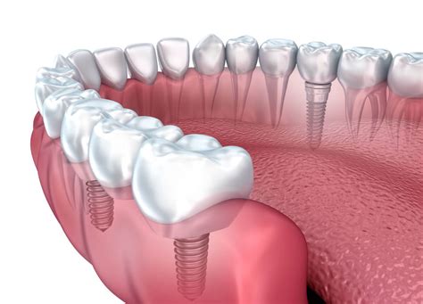 Cómo limpiar los implantes dentales