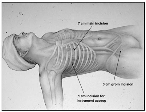 JCM Free Full Text Surgery And Catheter Ablation For Atrial