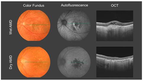 Blue Light Macular Degeneration Pubmed Shelly Lighting