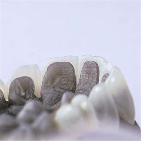 Carillas de Composite Estética Dental Clínica Bilbao