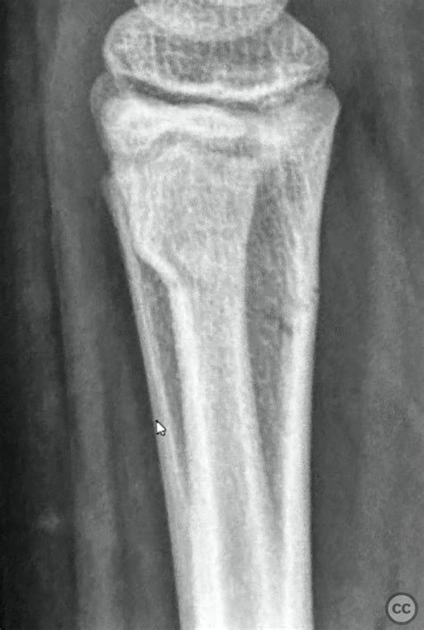 Misdiagnosed Greenstick Fracture Of The Distal Radius Lost Reduction