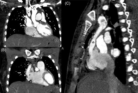 Ac Postoperative Computed Tomography Images Showing A Widely