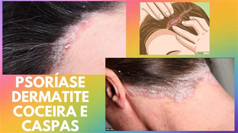 COMO SARAR DERMATITE CASPAS PSORÍASE NO COURO CABELUDO E CORPO Dica