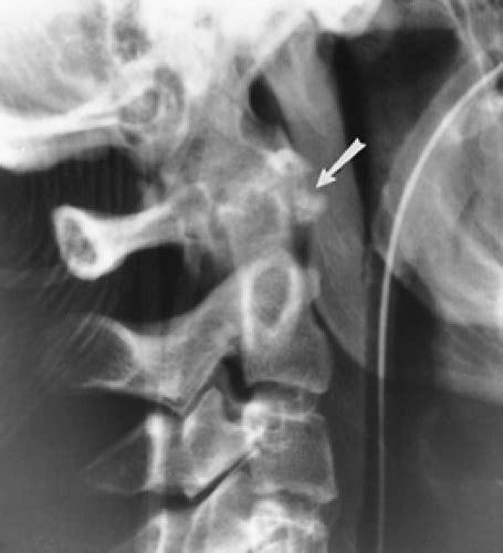 Posterior Arch Fracture