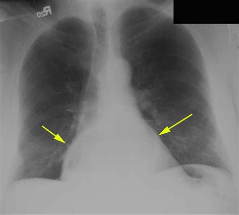 Chest X Ray Hiatal Hernia at Rory Pichardo blog