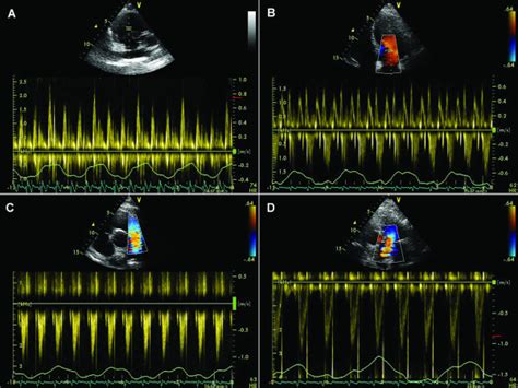 Physiological Variations Of The Velocity Across The Tricuspid Valve Download Scientific Diagram