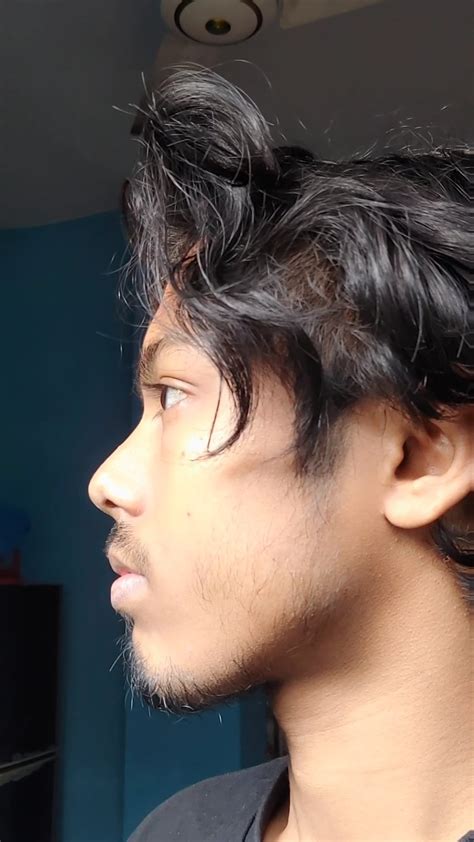 Recessed Maxilla Or Bimaxilary Protrusion Rmewing