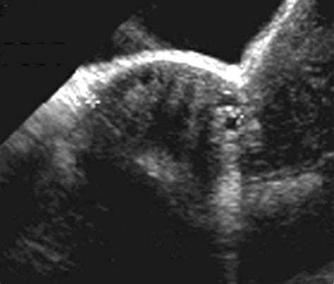 Quiz Sex Cord Stromal Tumors Flashcards Quizlet