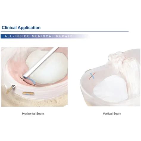 Canwell Meniscus Repair Suture Meniscal Tap Fast Fix Orthopedic Needle