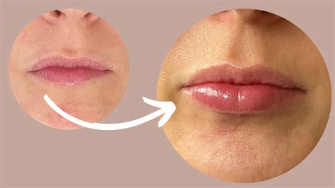 Natural Looking Lip Fillers For Thin Lips Dr Liesel Holler