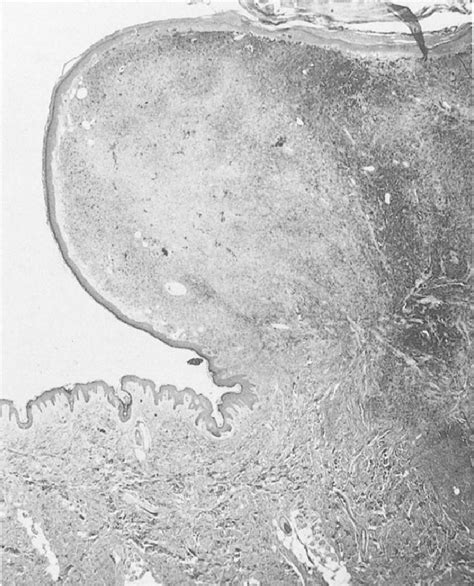 Cellular Blue Nevus Partial View Of A Large Pedunculated Pigmented