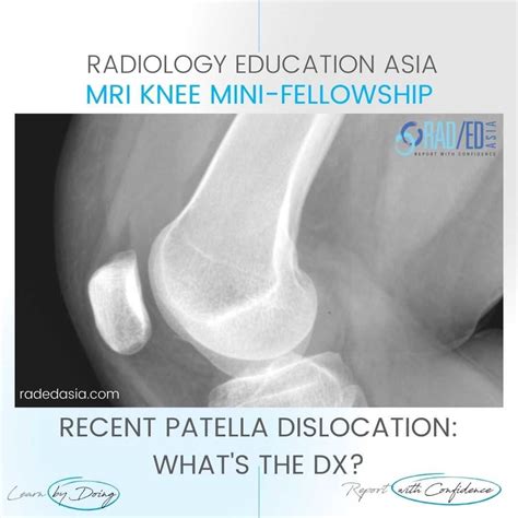 PATELLA DISLOCATION SUBLUXATION FRACTURE HEMARTHROSIS LIPOHEMARTHROSIS MRI KNEE RADIOLOGY ...