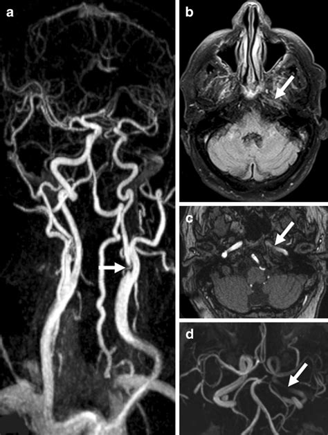 Example Of A Patient With Proximal Ica Stenosis A Contrast Enhanced Mr