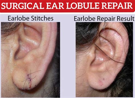 Ear Lobe Repair Treatment In New Sangvi Pune Life Care Speciality