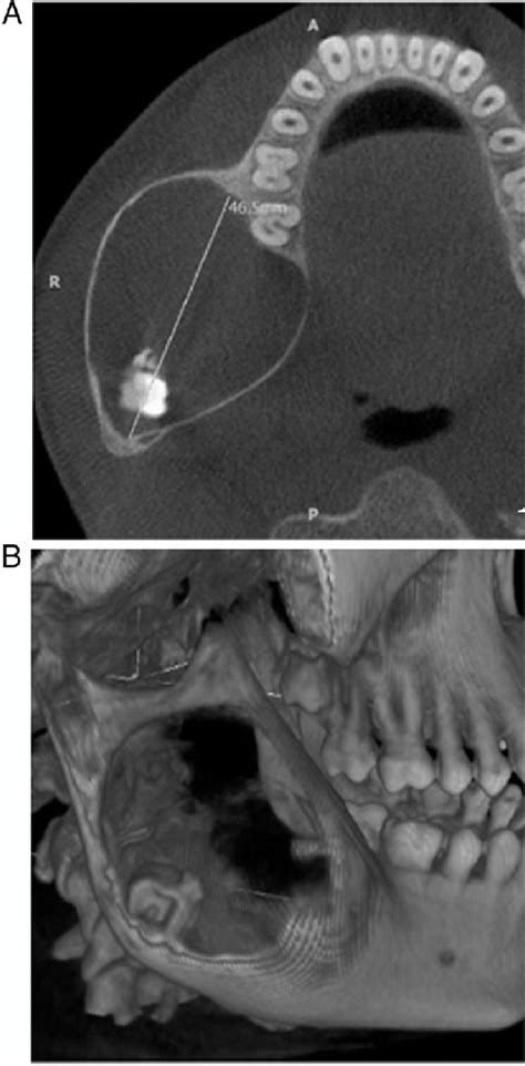 Figure From Ameloblastic Fibroodontoma In The Posterior Mandible A