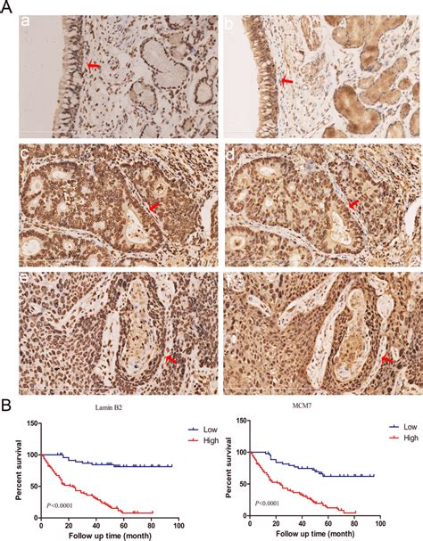 Lamin B And Mcm Expression In Clinical Nsclc Samples A