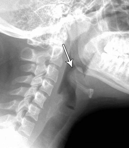 Retropharyngeal Abscess X Ray