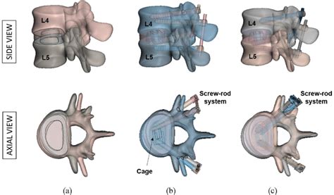 3D CAD models the L4-L5 FSU: (a) intact, (b) implanted with normal
