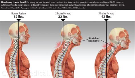 Forward Head Posture Symptoms And Complications Caring Medical Florida