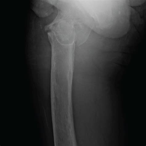 Anteroposterior A And Lateral B Radiographs Taken On Initial